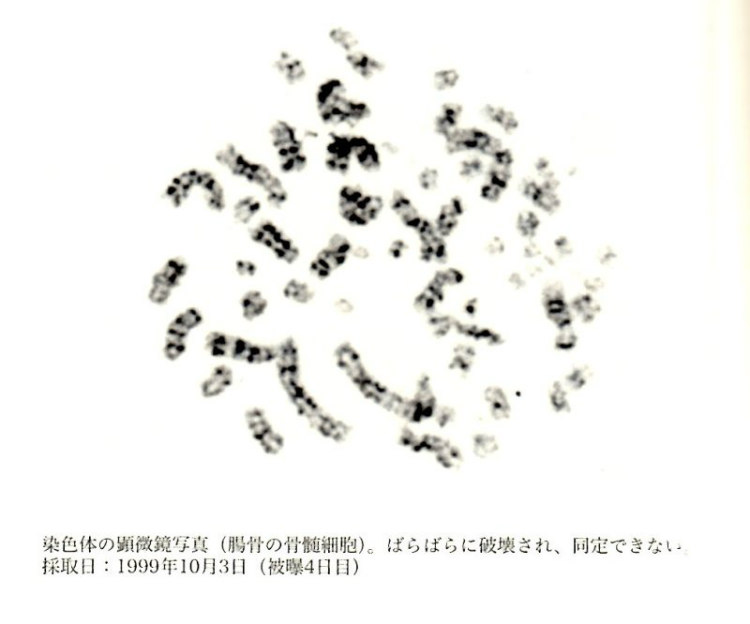 Kromosom Rusak Ouchi Setelah Kecelakaan Nuklir Tokaimura, 1999